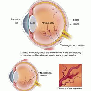 Type Ii Diabetes Cures - Borderline Diabetes Cure That Is Working Very Well